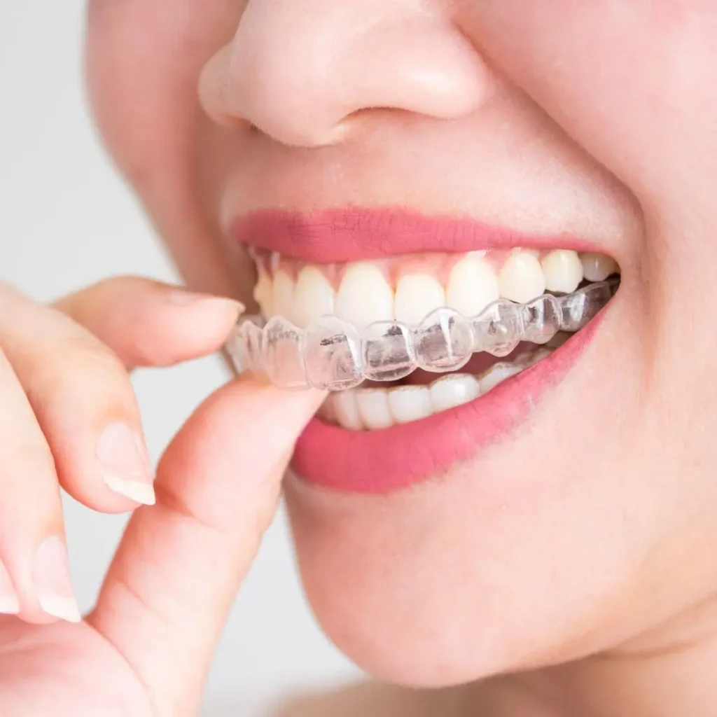 Alinhador Invisalign